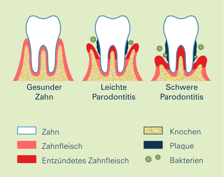 2017-12-16 Parodontalbehandlung